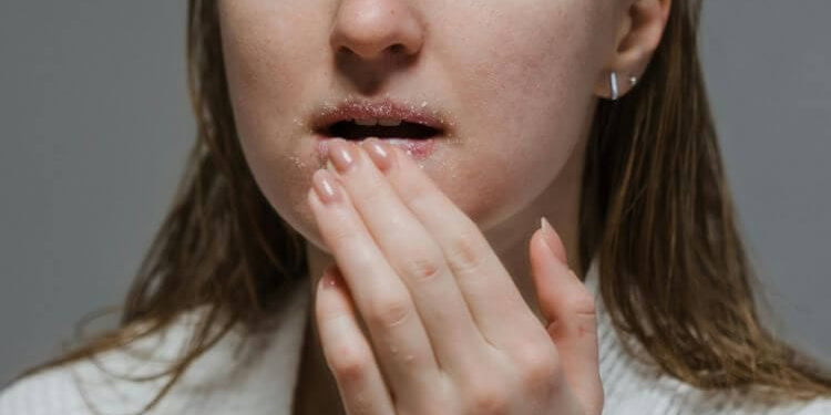 Glycolic Acid Lips: Is It Safe for Dry, Flaky Lips?