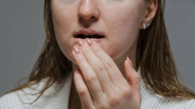 Glycolic Acid Lips: Is It Safe for Dry, Flaky Lips?