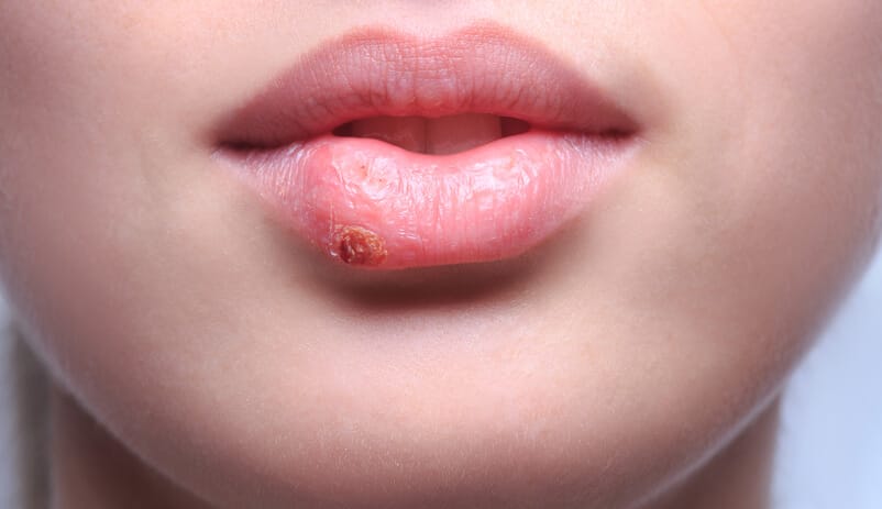 Chapped Lips With Chron’s Disease, Sjogren’s Syndrome and Celiac Disease.