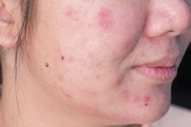 Dermatitis Herpetiformis is a skin condition related to topical gluten in products such as makeup.