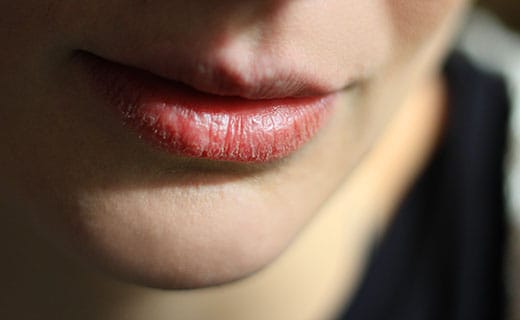 everyday lip care - very dry lips.